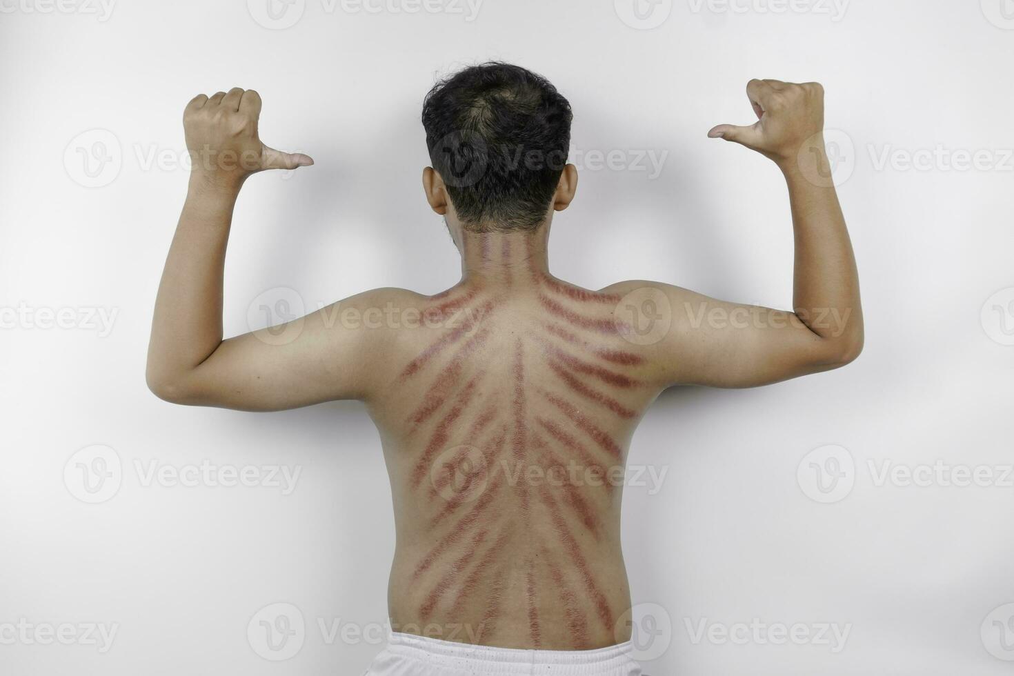rot Markierungen von Kratzer Münze auf ein des Mannes zurück. Kerokan ist ein Weg von traditionell javanisch Kultur medizinisch Behandlung zu behandeln Symptome von Erkältungen im Indonesien foto