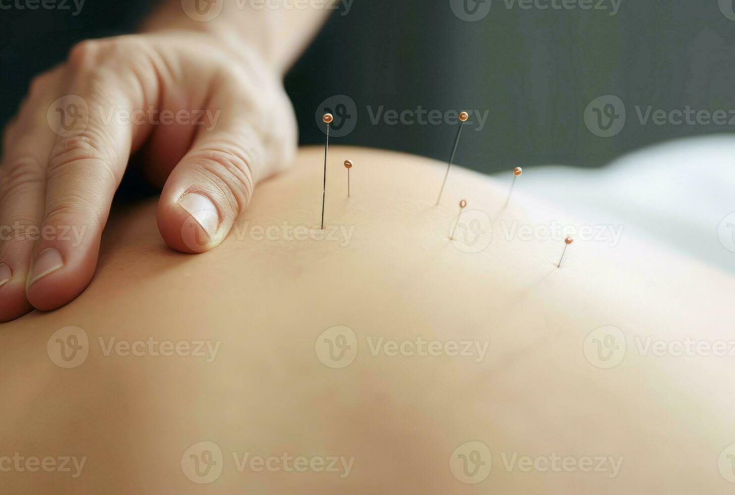 Akupunktur Behandlung Nadeln. generieren ai foto