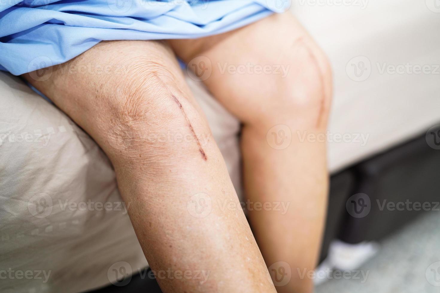 Asiatische Seniorin zeigt ihren chirurgischen Knieersatz mit Narbe im Krankenhaus foto