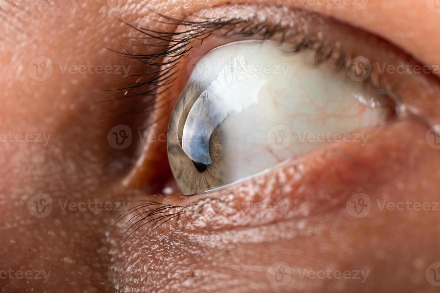 Auge mit Hornhautdystrophie Keratokonus-Krankheit Ausdünnung der Hornhaut foto