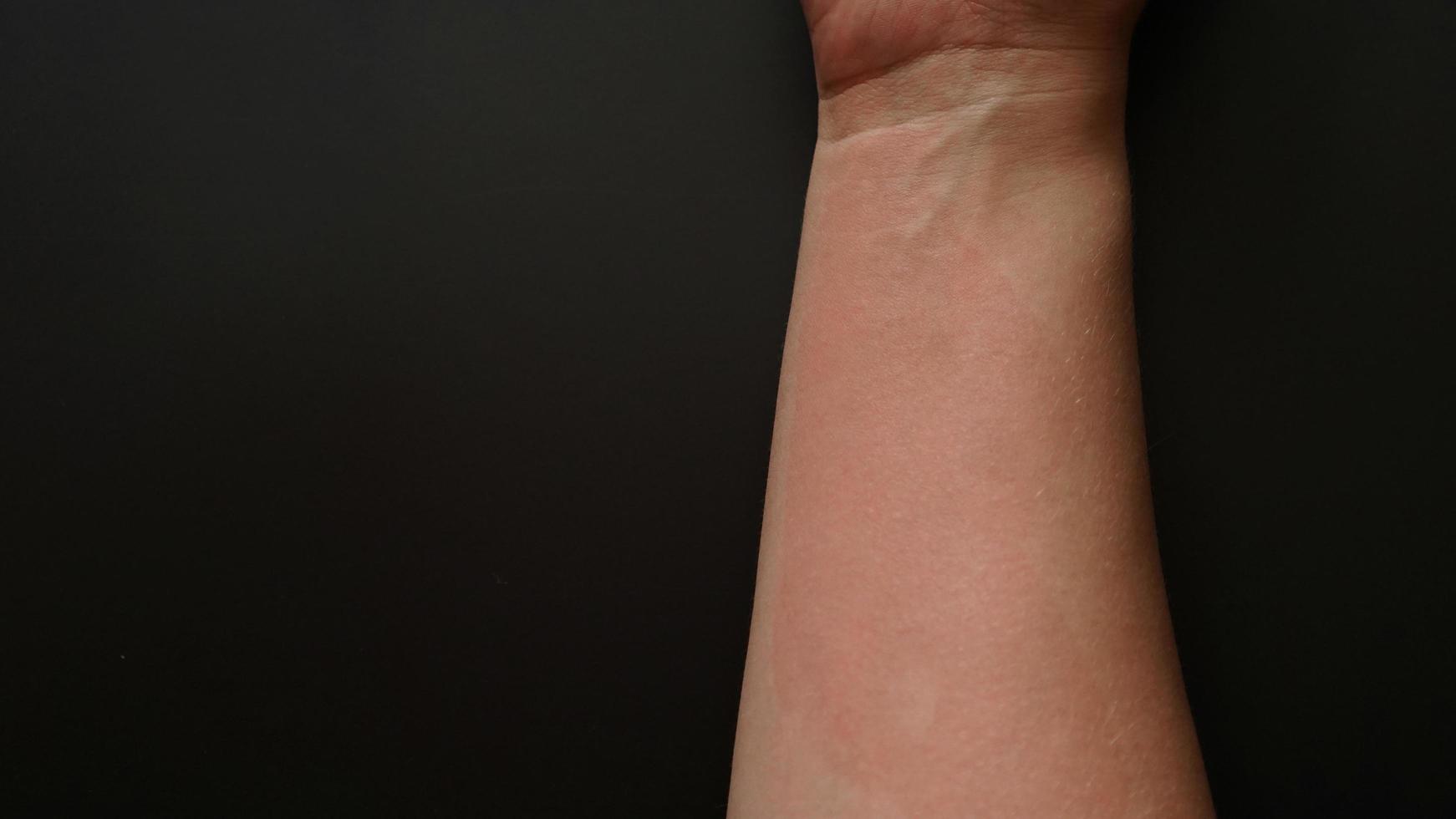 weibliche Hand mit roten Flecken bedeckt, Nahaufnahme. allergische Reaktion foto