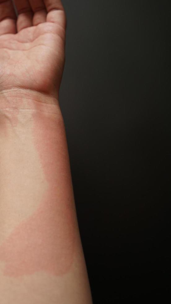 weibliche Hand mit roten Flecken bedeckt, Nahaufnahme. allergische Reaktion foto