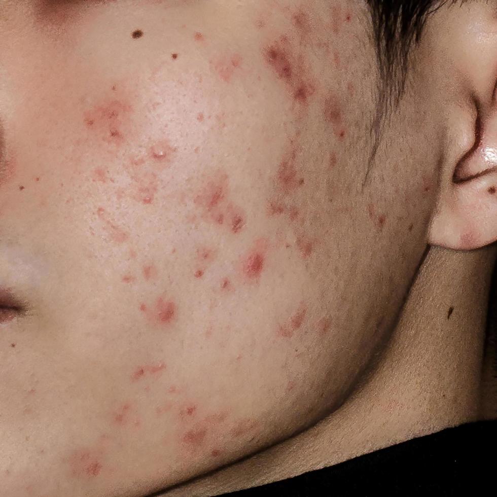 Nahaufnahme von Akne auf der Haut, Akne im Gesicht, die durch Hormone verursacht wird. foto