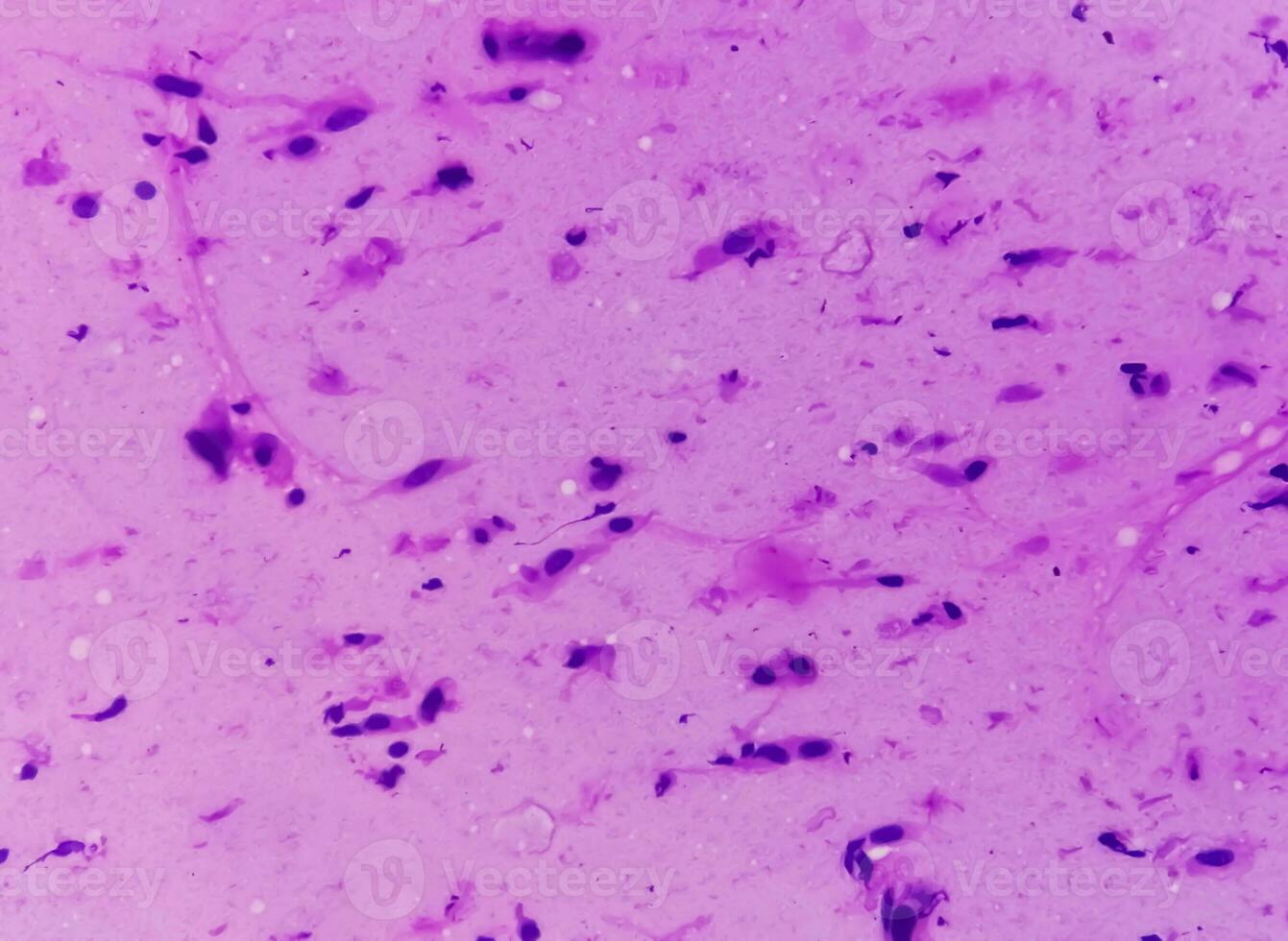 Mikrophotographie zeigen Neurofibrom. Neurofibromatose, ist ein genetisch Störung, Gen Mutationen. foto