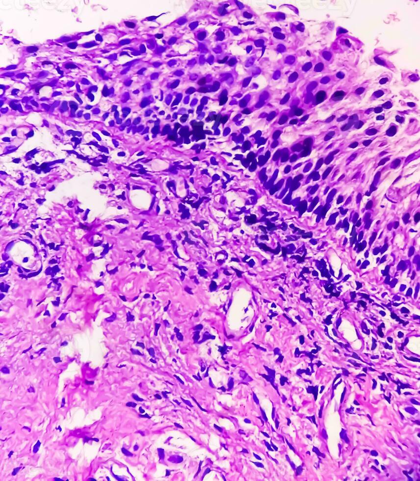 Histologie von Urachal Zyste. Mikrophotographie von histologisch befleckt rutschen zeigen Urachal Zyste. Harnröhre Zyste. foto