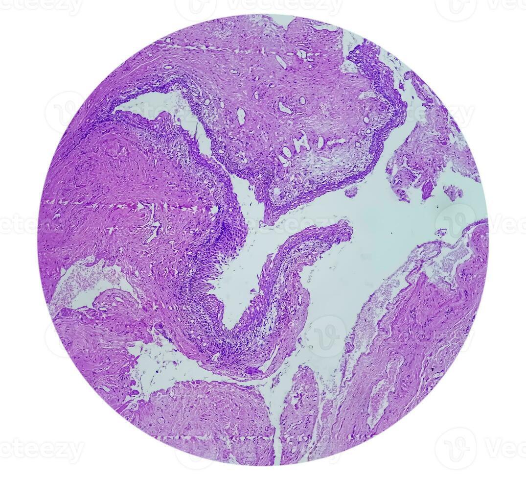 Histologie von Urachal Zyste. Mikrophotographie von histologisch befleckt rutschen zeigen Urachal Zyste. Harnröhre Zyste. foto