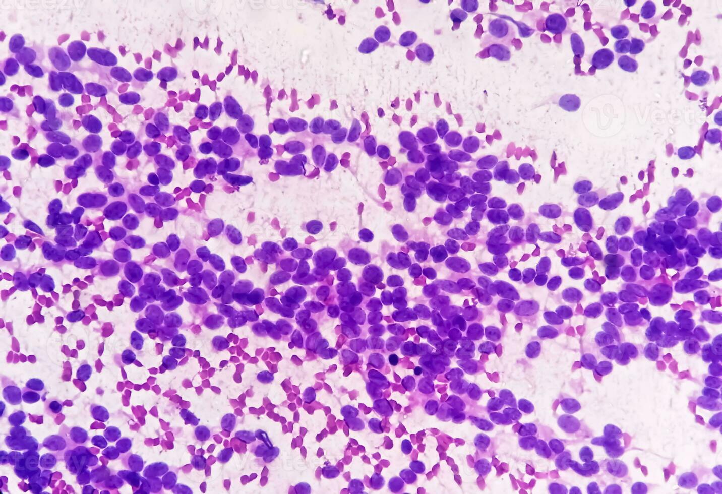 usg geführt fna Zytologie von Leber Sol zeigen nicht hodgkin Lymphom. metastatisch Karzinom foto