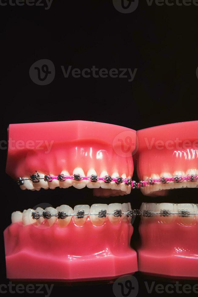 das Hosenträger sind auf das Zähne im das künstlich Kiefer auf ein schwarz Hintergrund. Nahansicht foto