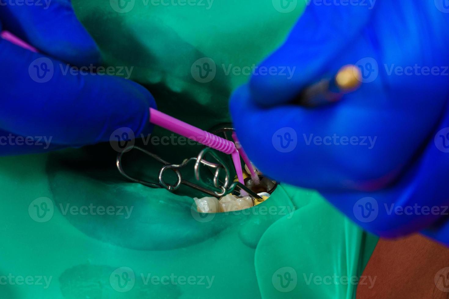 Arzt verwendet Kofferdam, um Zähne zu behandeln, foto