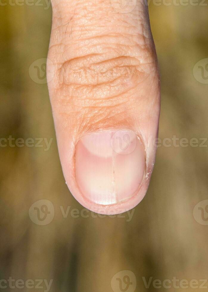 gegabelt Nagel auf das Daumen. Erweiterung von das Nagel, traumatisch Pathologie. das Nagel ist geteilt im Hälfte foto