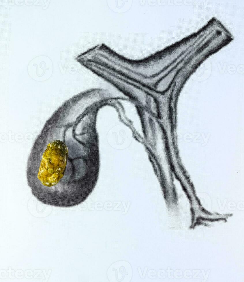 Galle Blase Stein, schematisch Darstellung, groß Größe Gallenstein, Ergebnis von Gallenstein Krankheit. foto