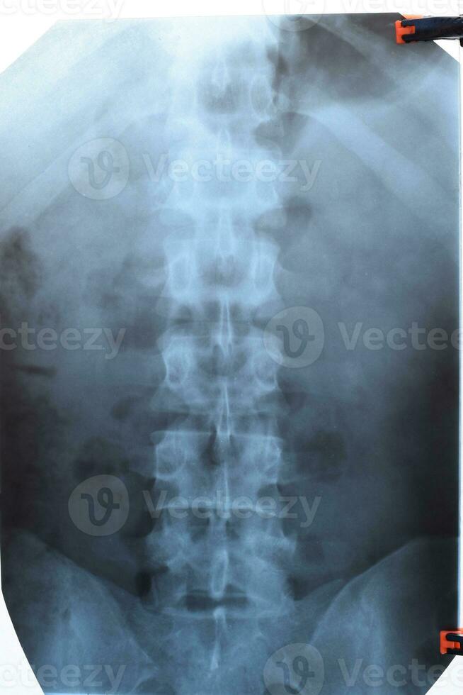 x Strahl von das Lendenwirbelsäule Wirbelsäule, Rücken auf Röntgen foto