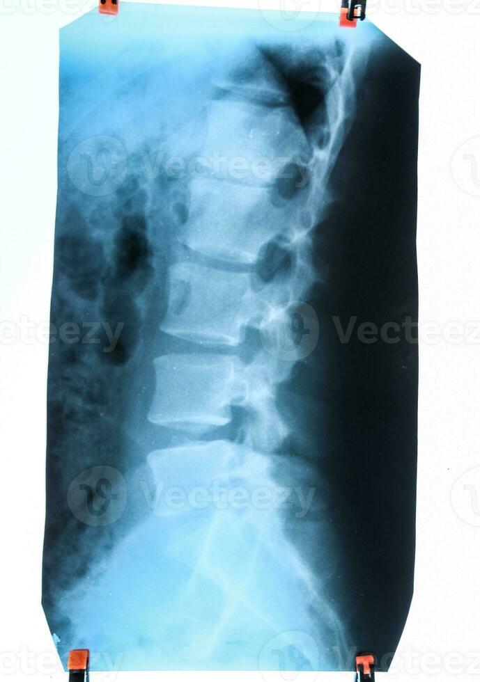 x Strahl von das Lendenwirbelsäule Wirbelsäule, Rücken auf Röntgen foto
