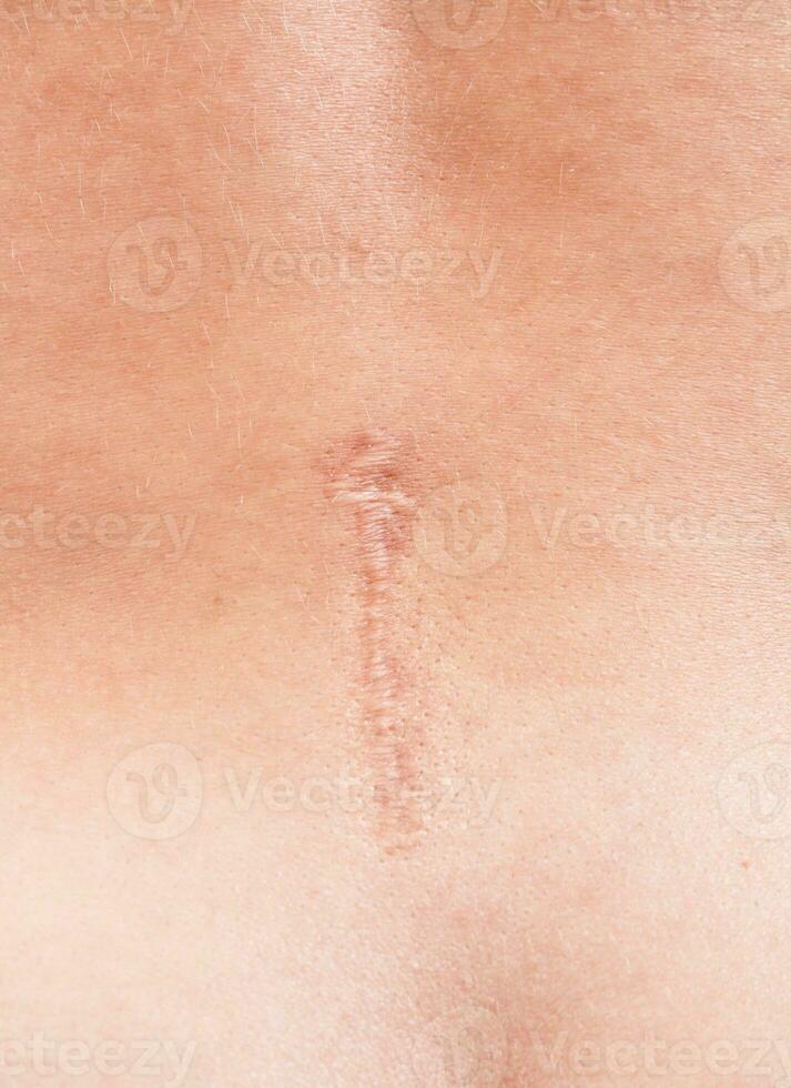Narbe auf das weiblich zurück nach das Rücken Chirurgie foto