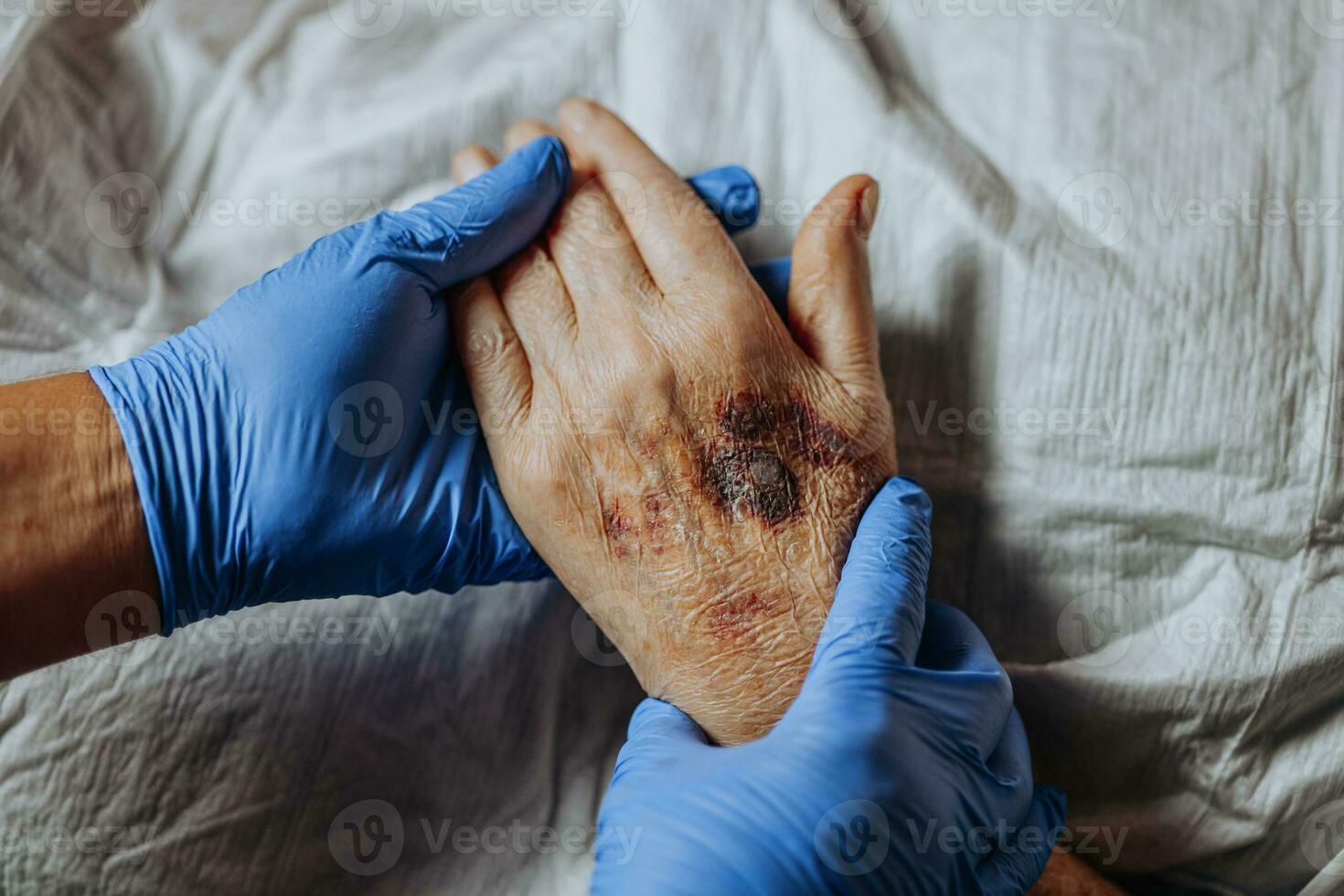 ein Prellung auf das Hand von ein Alten Person. bekannt wie senil Purpura. verursacht durch das Zerbrechlichkeit von das Haut und Blut Schiffe im alt Alter. Alten Pflege foto