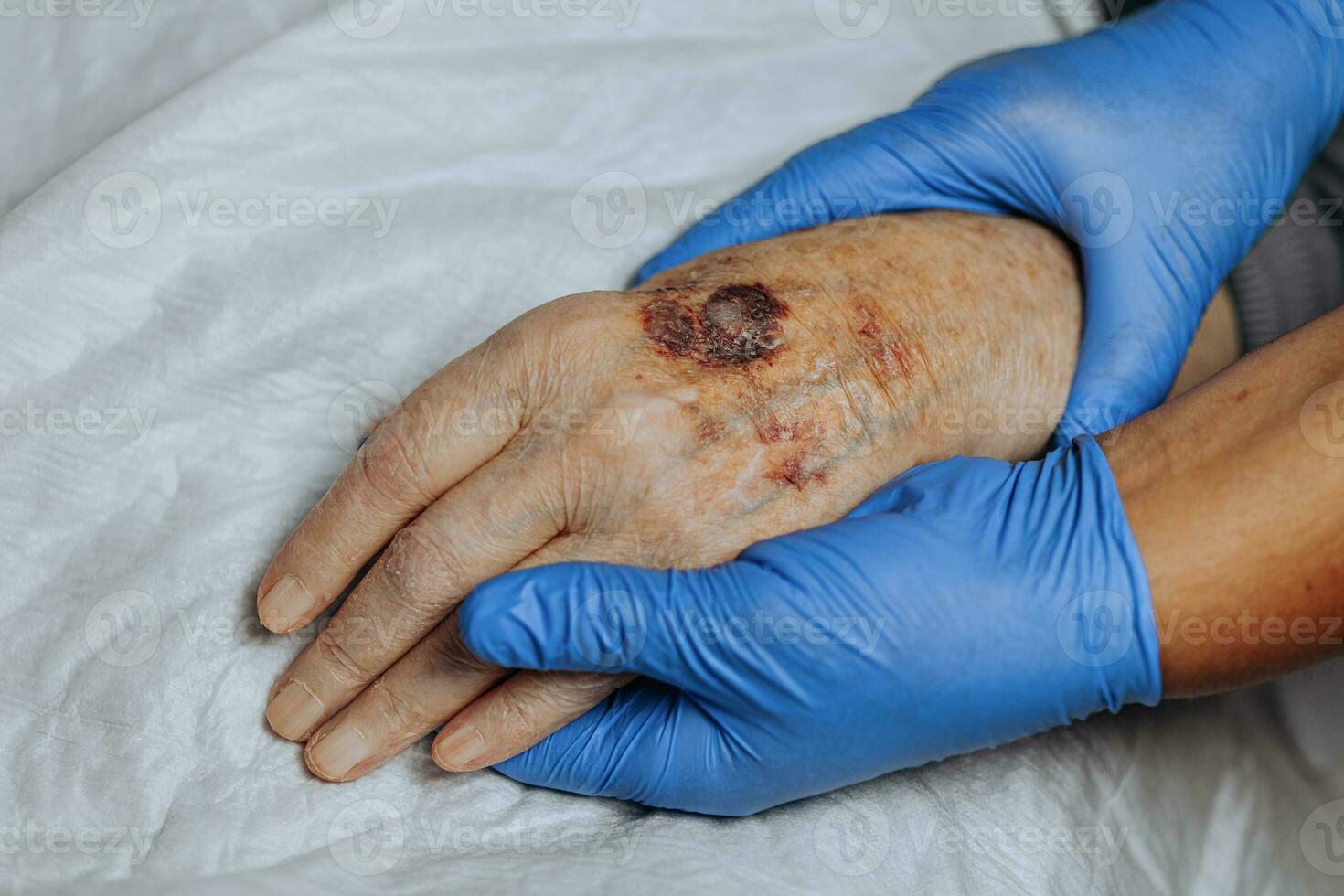 ein Prellung auf das Hand von ein Alten Person. bekannt wie senil Purpura. verursacht durch das Zerbrechlichkeit von das Haut und Blut Schiffe im alt Alter. Alten Pflege foto