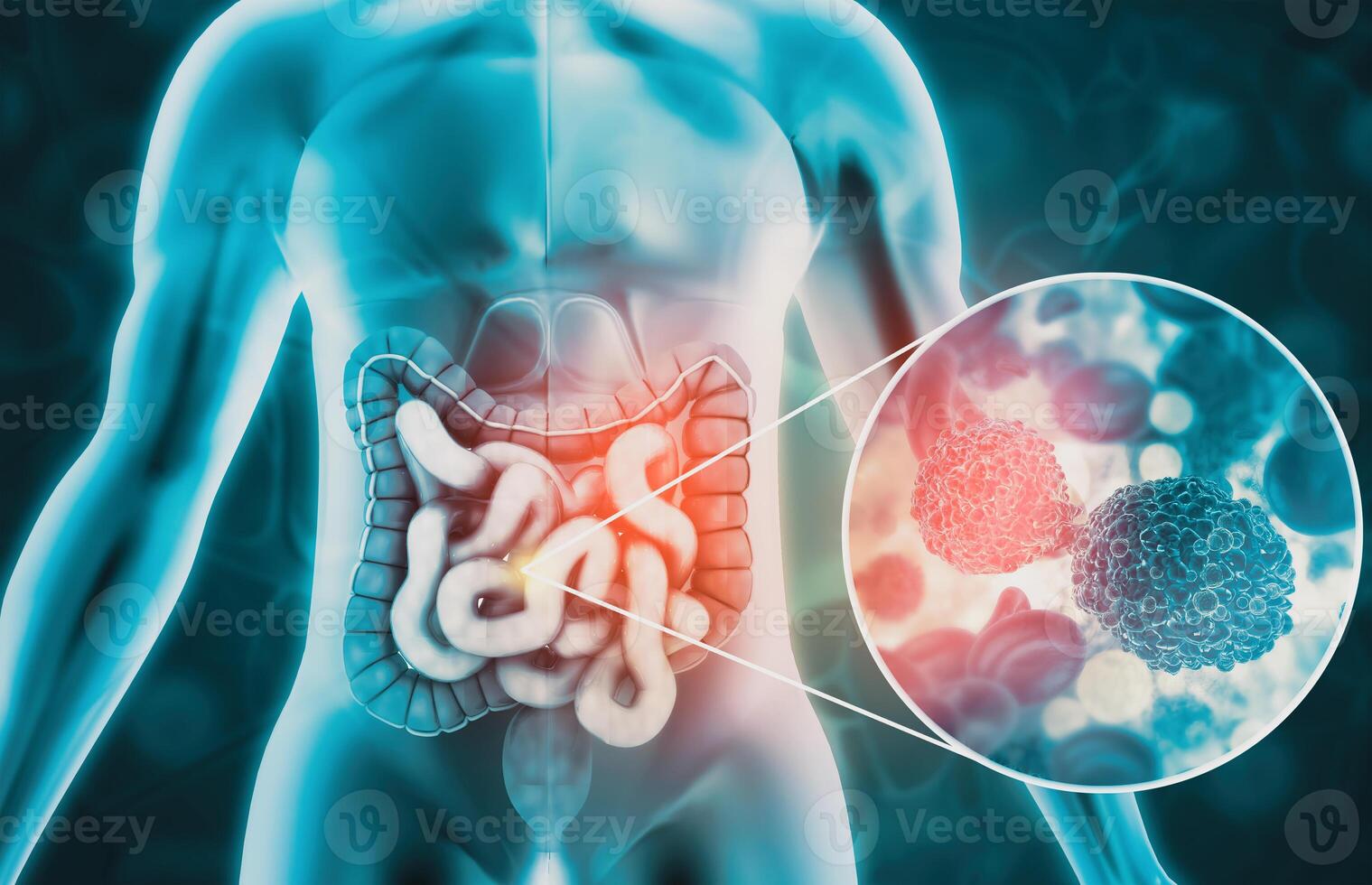 Mensch Körper Anatomie. Doppelpunkt Krebs, Doppelpunkt Krankheit Konzept, 3d Illustration foto