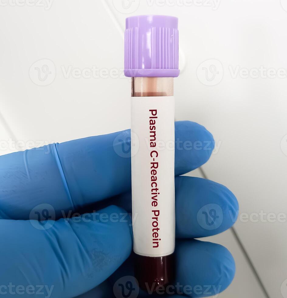 Blut Stichprobe zum Plasma Crp Ebenen bedeutend vorhersagen größer Risiko von ischämisch Schlaganfall oder tia im Alten Männer und Frauen. foto