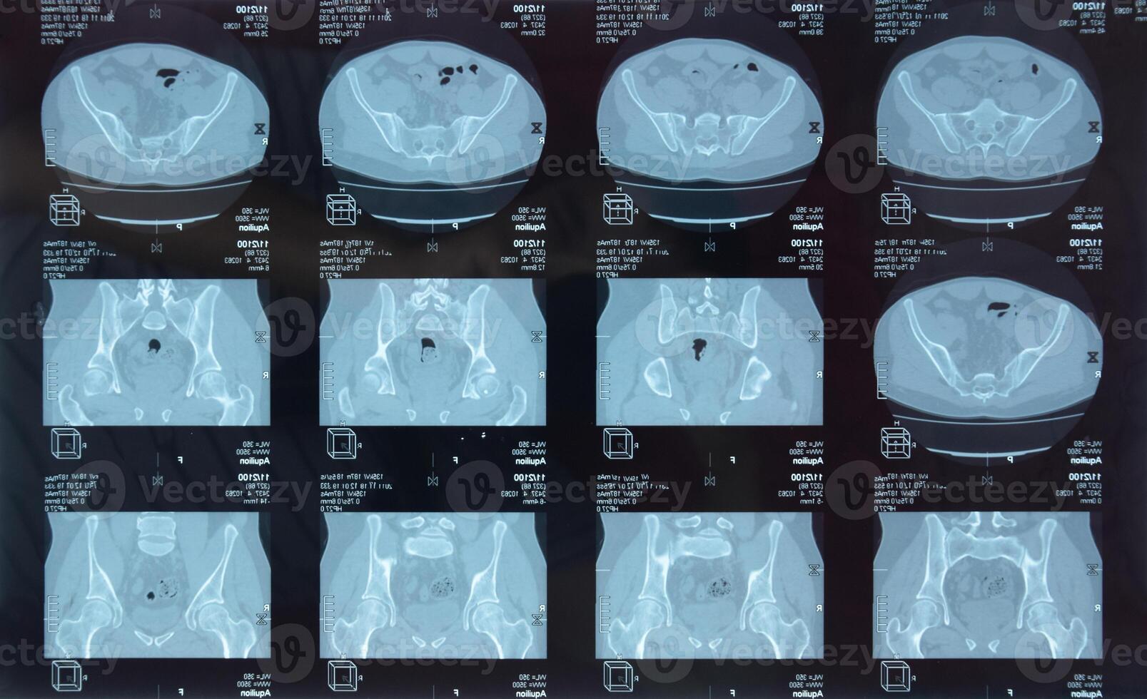 mri Iliosakral Artikulation. Studie von ankylosieren Spondyloarthritis geduldig. foto