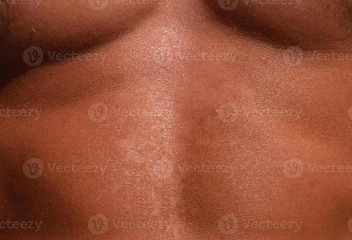 Sonnenbrand auf das Haut von das Magen. Peeling, Haut schält aus. gefährlich Sonne bräunen foto