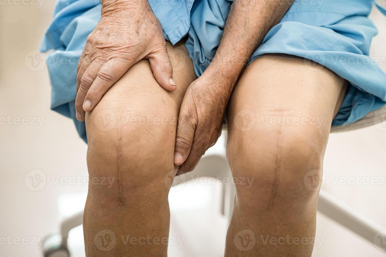 asiatisch Alten Frau geduldig Show ihr Narben chirurgisch gesamt Knie Joint Ersatz Naht Wunde Chirurgie Endoprothetik auf Bett im Krankenhaus. foto