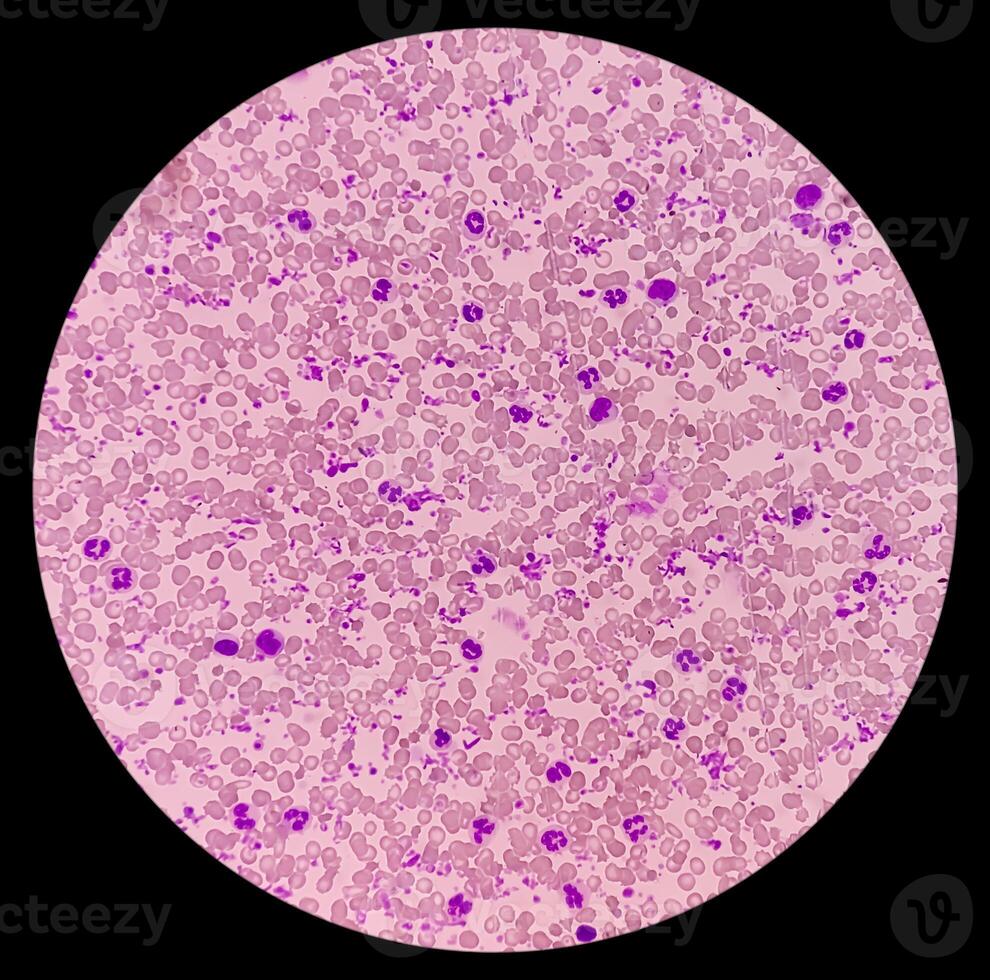 wesentlich Thrombozytose Blut Abstrich zeigen abnormal hoch Volumen von Plättchen und Weiß Blut Zellen. Panmyelose. myeloprokiferativ Störung. foto