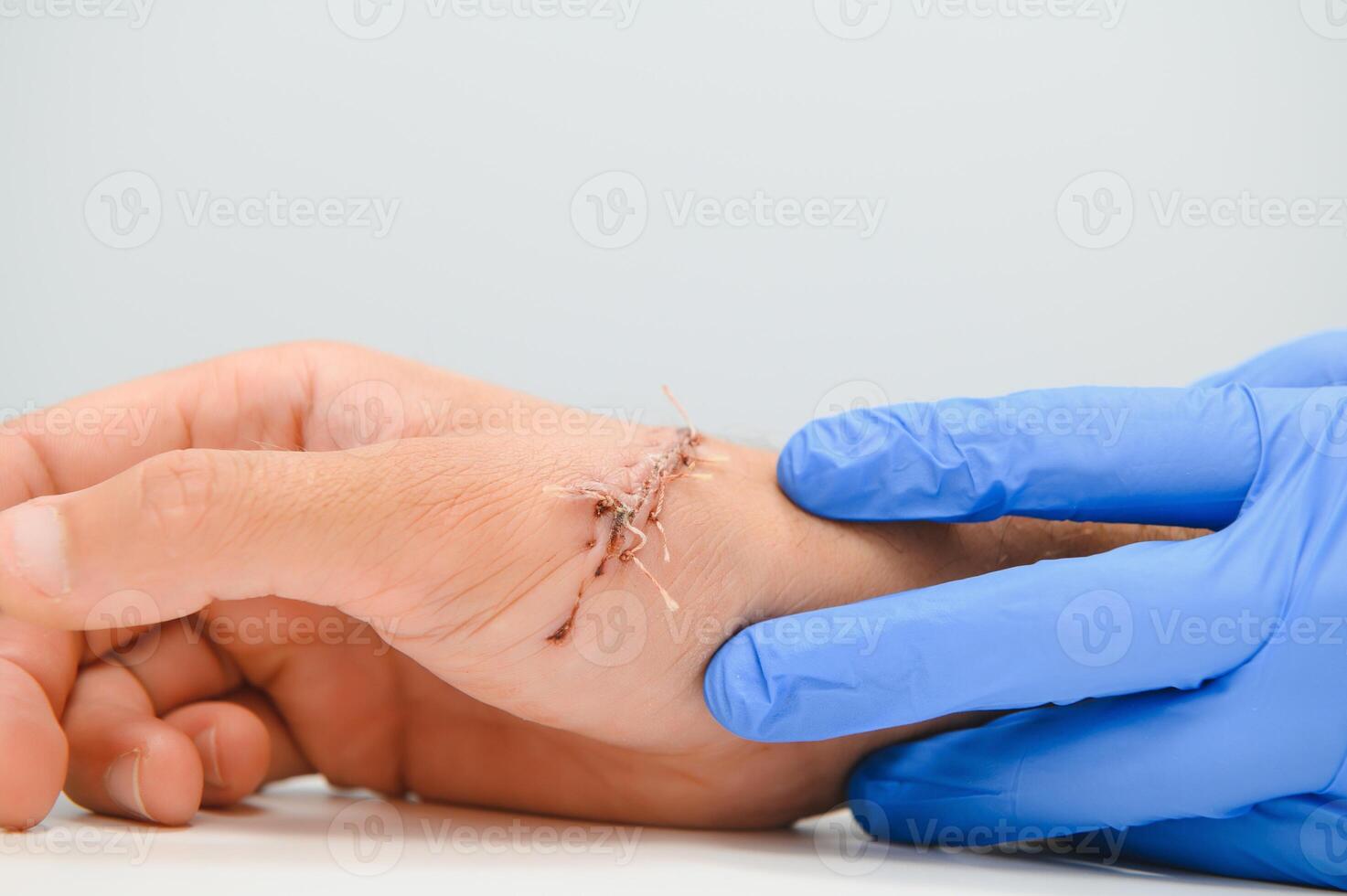 Untersuchung durch ein Arzt von ein Schnitt auf das Arm foto