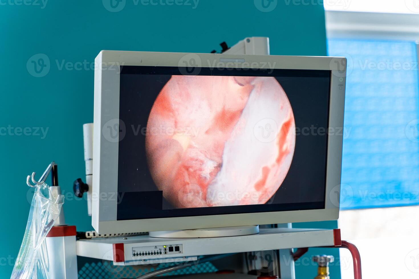 Prozess von Chirurgie Betrieb mit laparoskopisch Ausrüstung. Betriebs Zimmer mit Chirurgie Ausrüstung. medizinisch Hintergrund. Überwachung das Prozess auf Bildschirm. foto