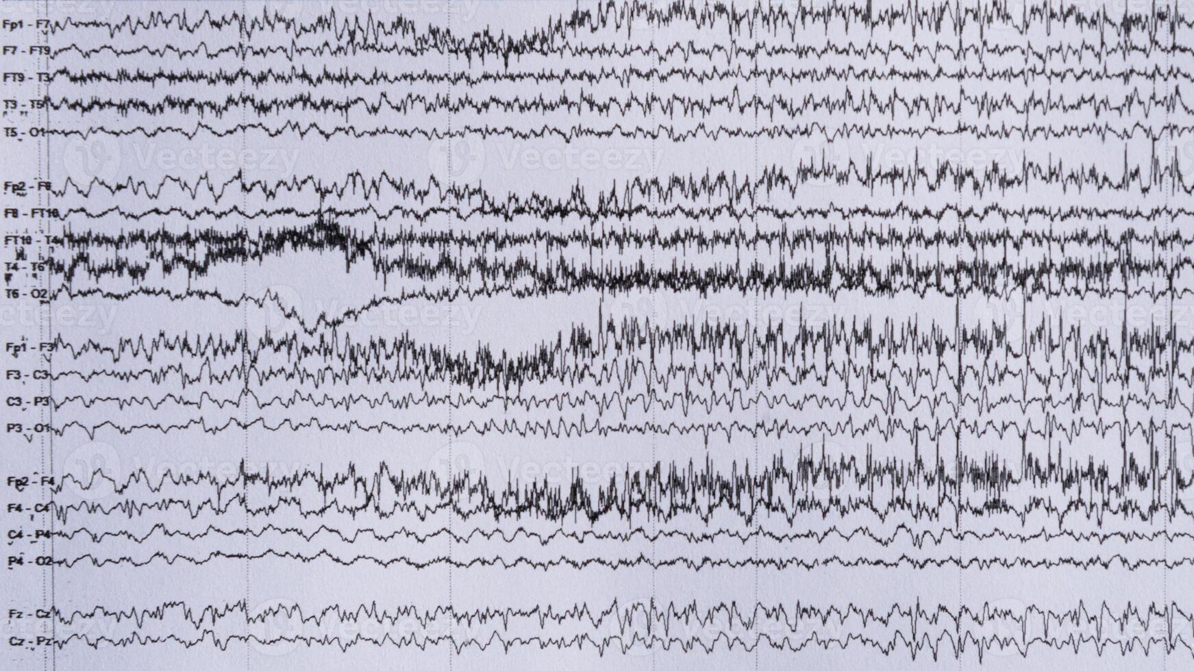 Bildgebung von iktal eeg Aufzeichnung im Epilepsie geduldig foto