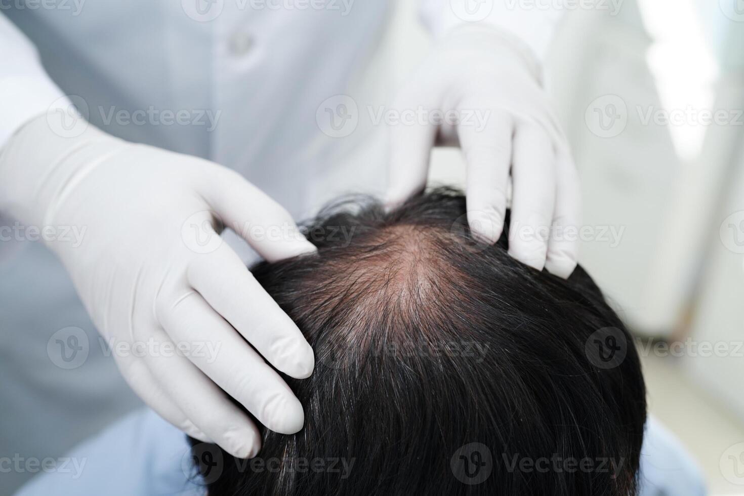 Arzt berühren Fett gedruckt Kopf im Mann, Haar Verlust Behandlung Gesundheit Problem. foto