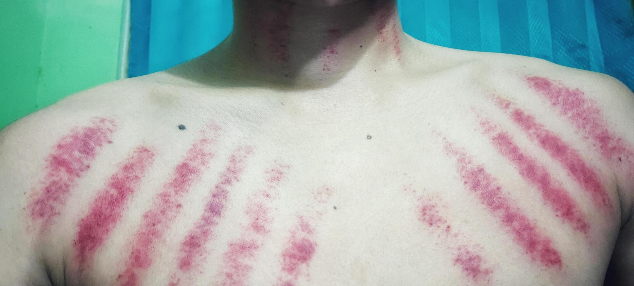 rot Markierungen von Münze Kratzer auf ein des Mannes Brust. Kerokan ist ein traditionell javanisch Behandlung Methode zum Behandlung das Symptome von Erkältungen. diese Behandlung Methode ist ziemlich Beliebt im Indonesien foto