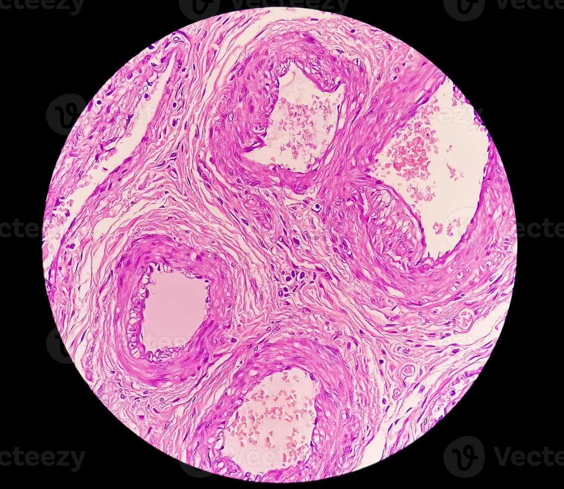 Histologie, peritoneal Aufnahme Zyste. Paraovariell Zysten, Hydrosalpinx und minderwertig zystisch Mesotheliom sind in der Regel berücksichtigt im das Differential Diagnose von Bilder. foto