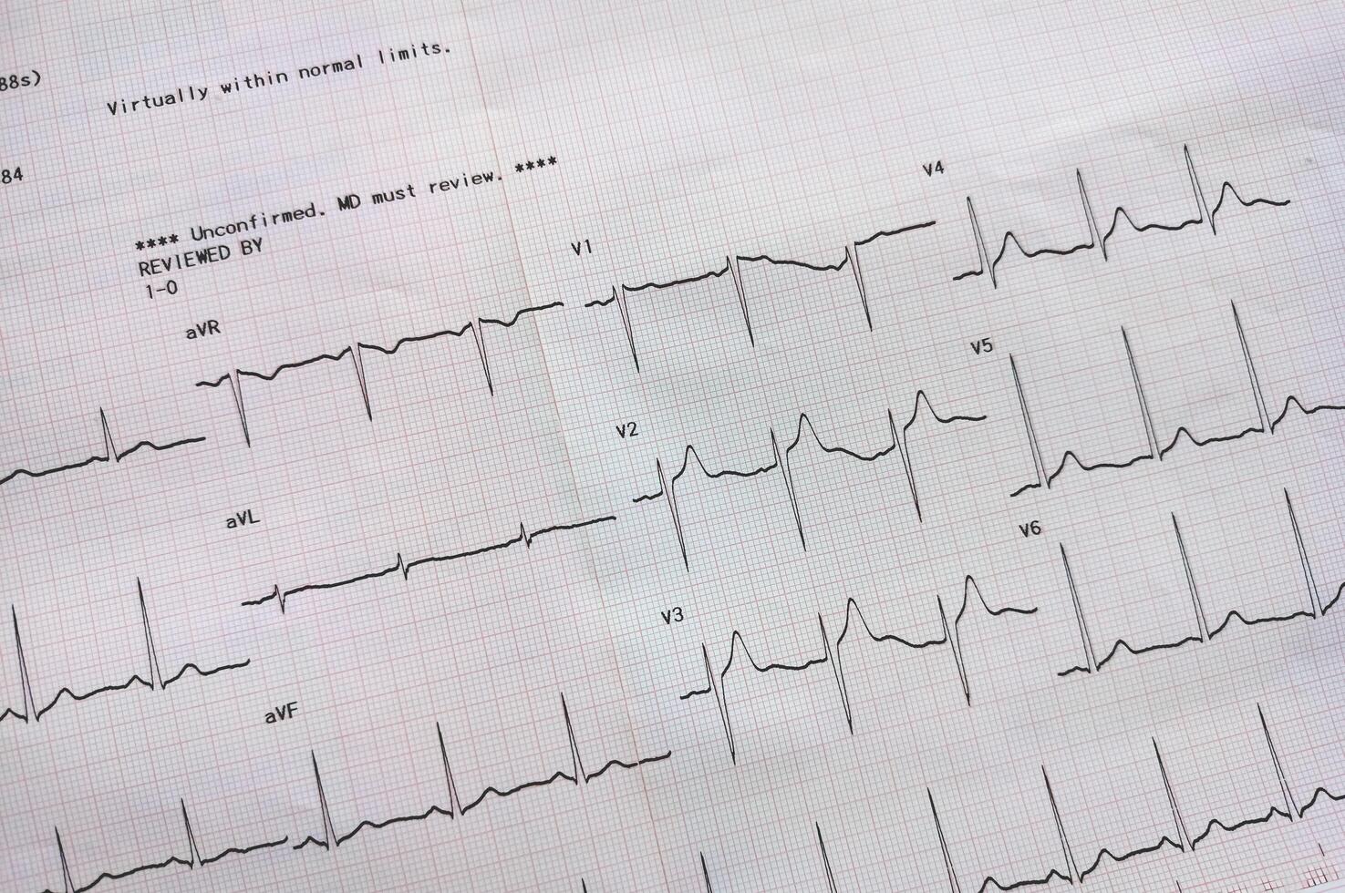 Graph zeigen das Ergebnisse von das Elektrokardiogramm Prüfung auf Aufzeichnung Papier. foto