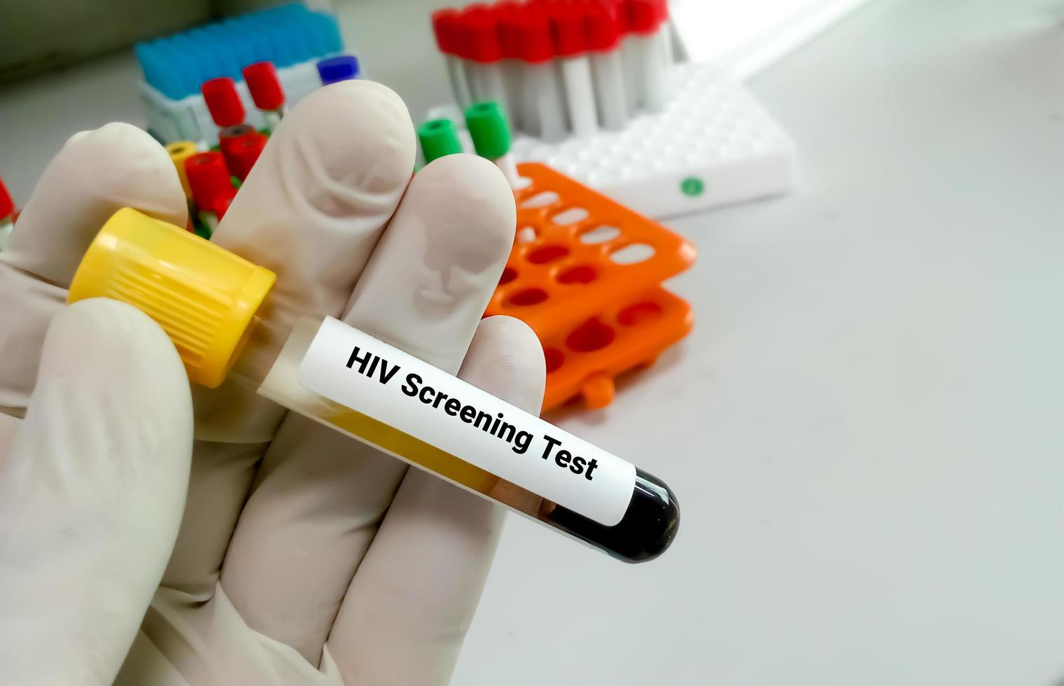Probenblutentnahmeröhrchen mit HIV-Testetikett. HIV-Screening-Test foto