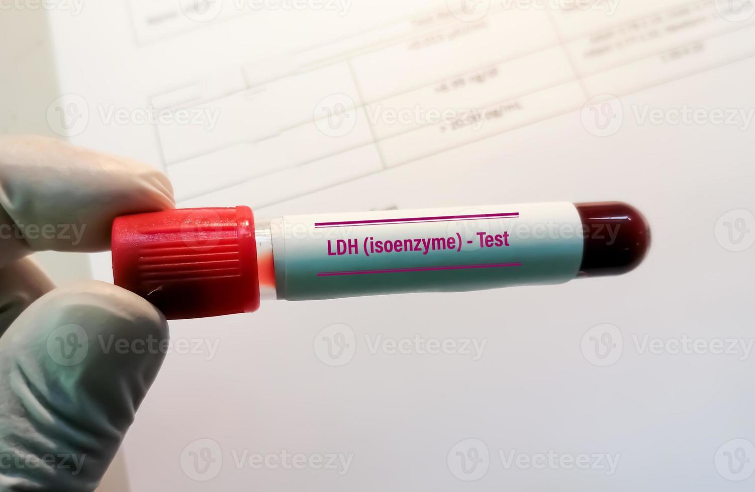 Blutprobe für ldh - Isoenzymtest. Aktatdehydrogenase, Diagnose auf Zellzerstörung oder Gewebeschädigung. foto