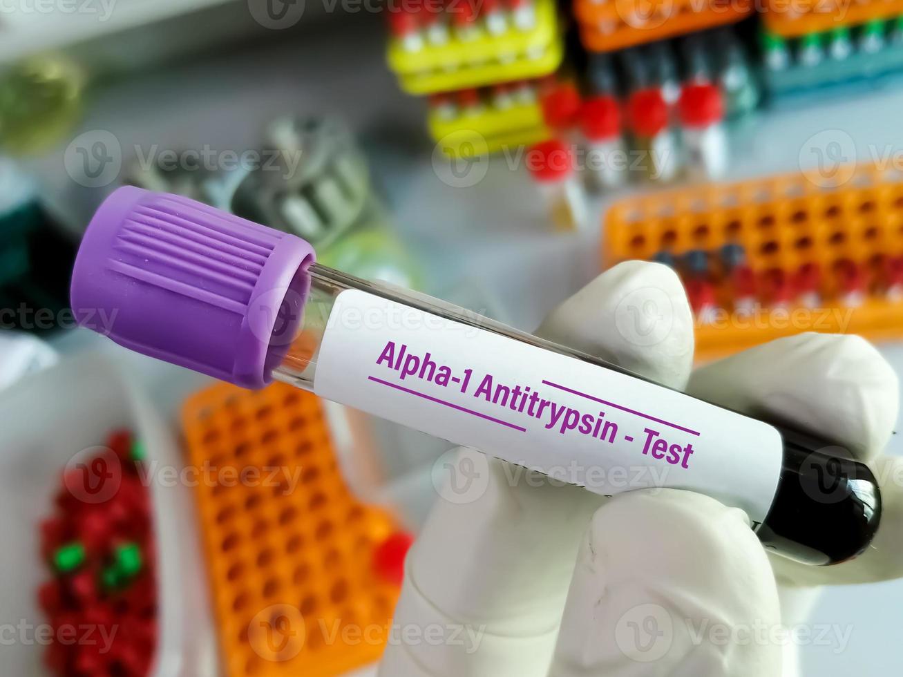 Wissenschaftler halten Blutprobenröhrchen für den Alpha-1-Antitrypsin-Test. Alpha-1-Antitrypsin-Mangel, kopd.. foto