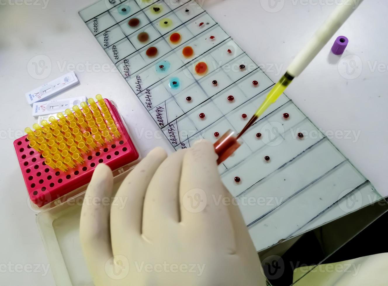 Abo Blutgruppenbestimmung durch Objektträgertesttechnik. Techniker, der Blutgruppenbestimmung durchführt. foto