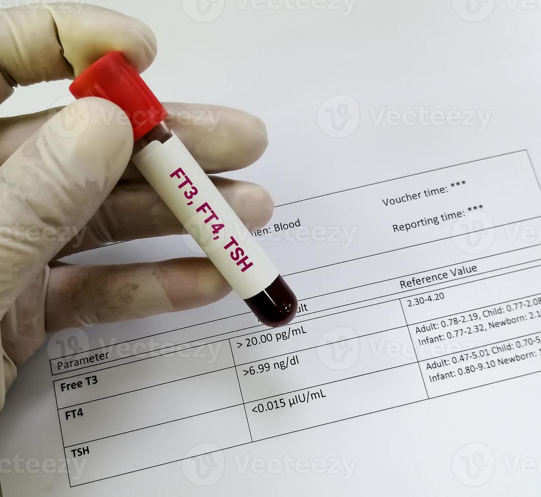 biochemiker halten blutprobe mit anormalem bericht über isoliertes schilddrüsenhormon. Hyperthyreose foto