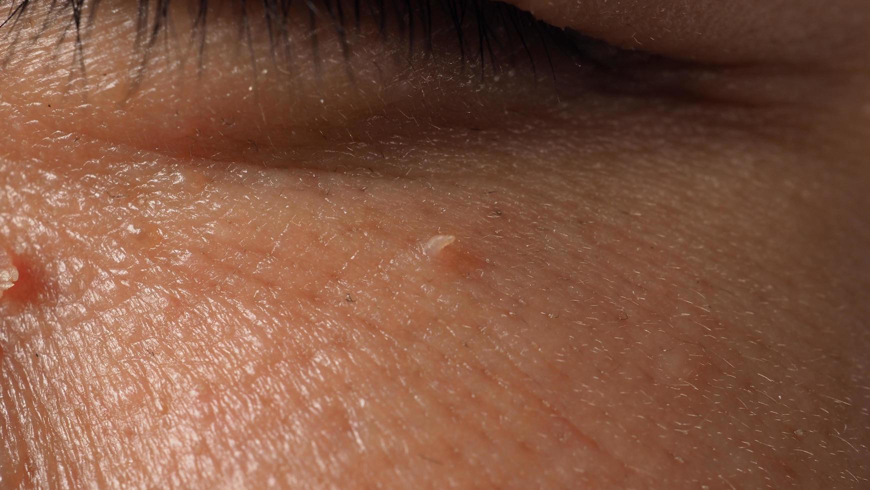 Warze im Gesicht. Makroaufnahme der Warze in der Nähe des Auges. Papillom auf der Haut. foto
