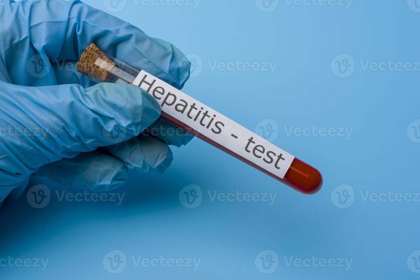 Hepatitis-Test, Blut im Reagenzglas. foto