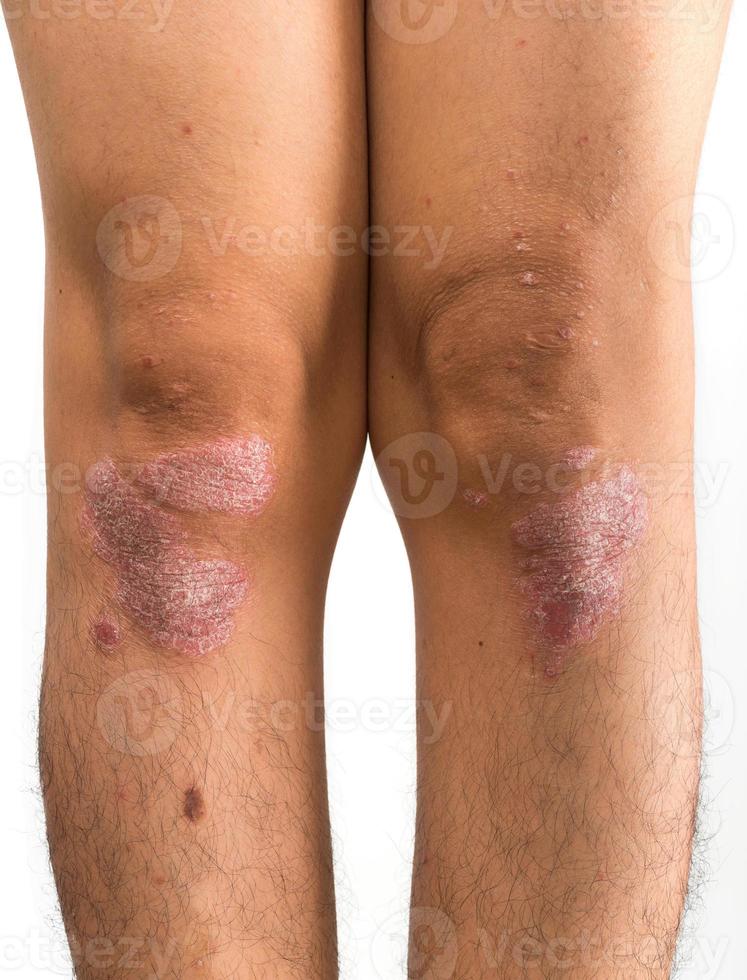 Psoriasis, dass Knie auf weißem Hintergrund foto