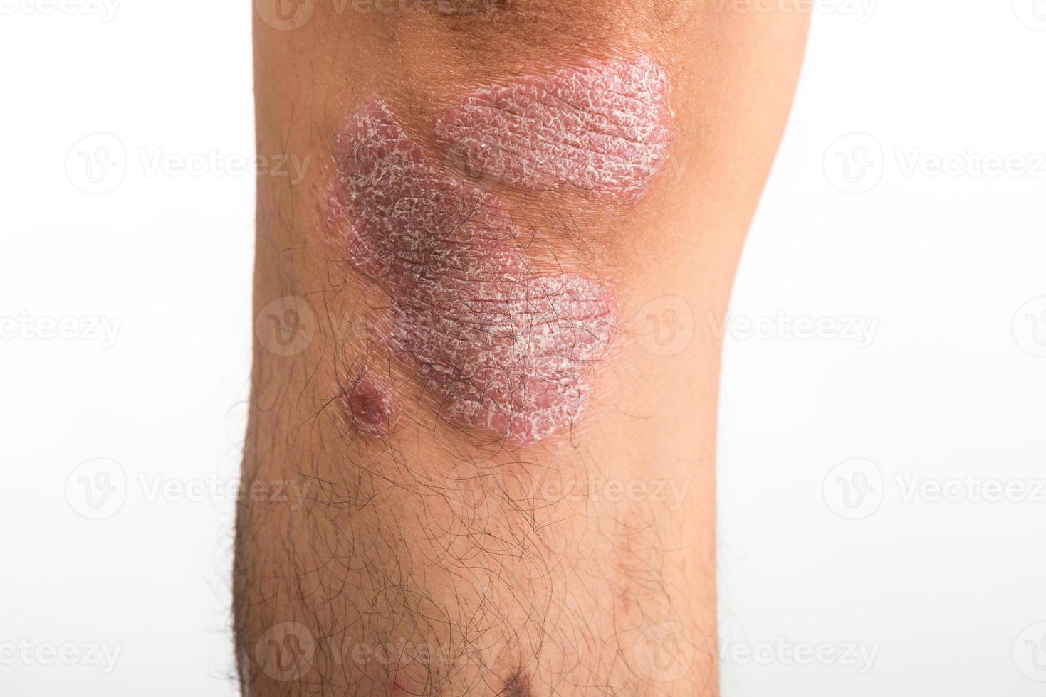 Psoriasis, dass Knie auf weißem Hintergrund foto