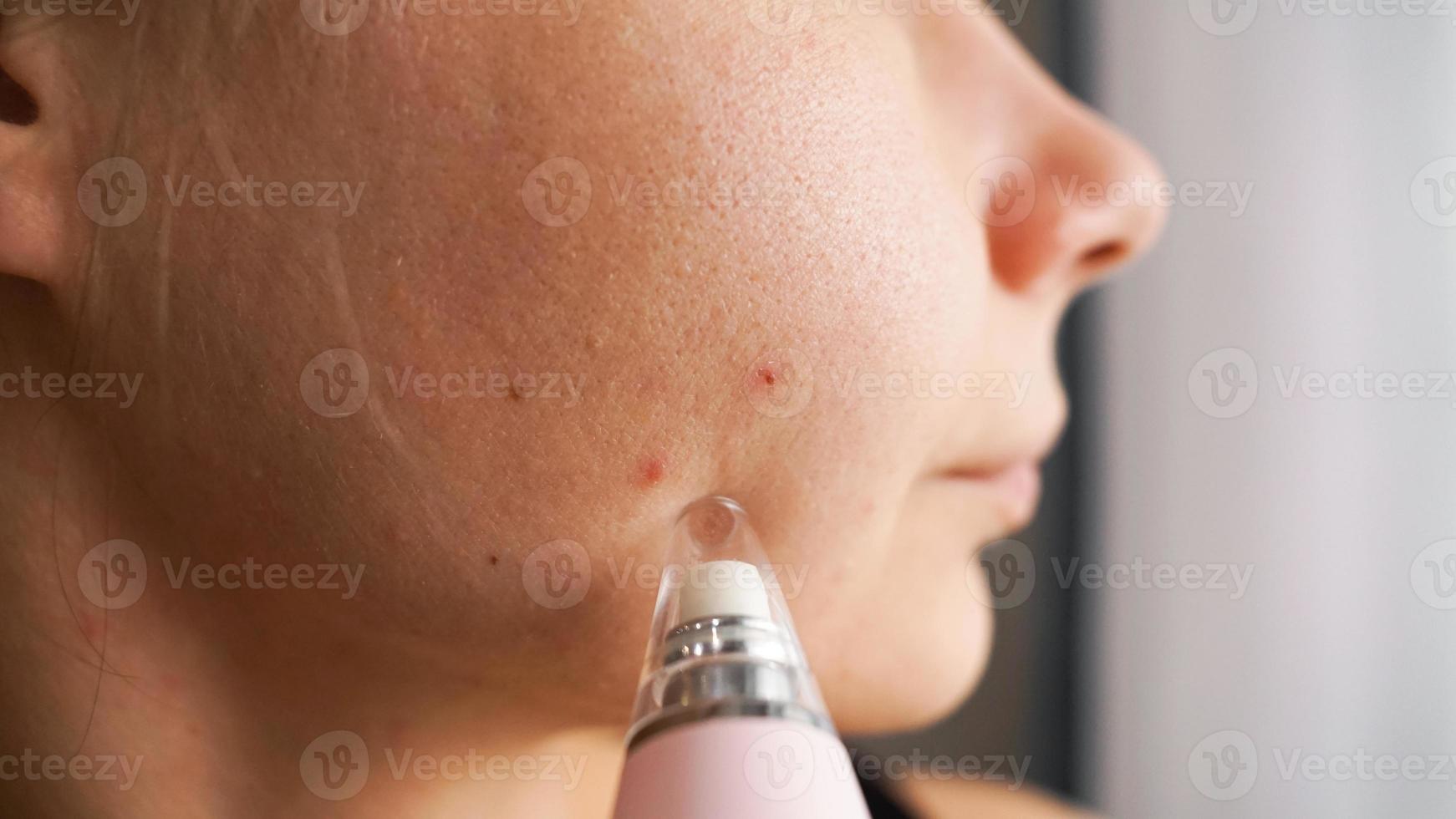 Vakuumgerät zum Entfernen von Mitessern und Akne aus dem Gesicht foto