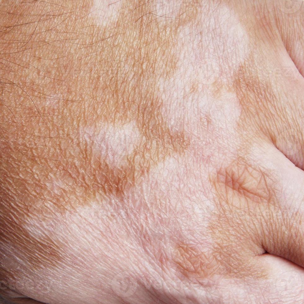 Nahaufnahmehand mit Vitiligo-Hautzustand foto