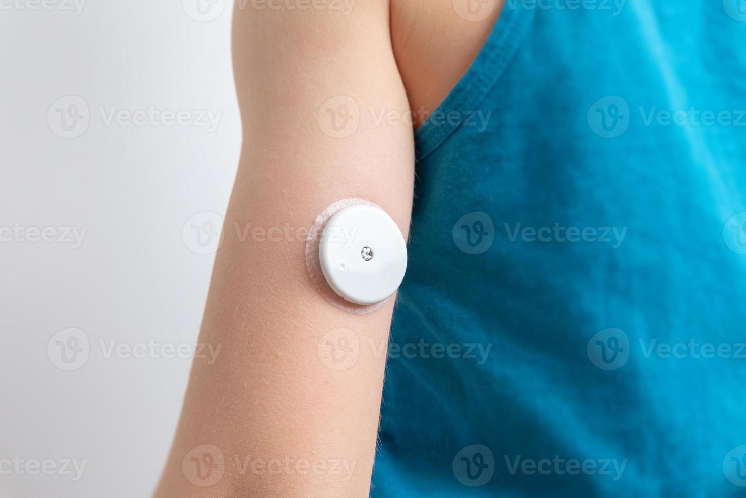 Blutzuckersensor am Arm eines Kindes. Sensor zur Fernmessung des Blutzuckerspiegels mit NFC-Technologie auf einem Mobiltelefon oder Lesegerät foto