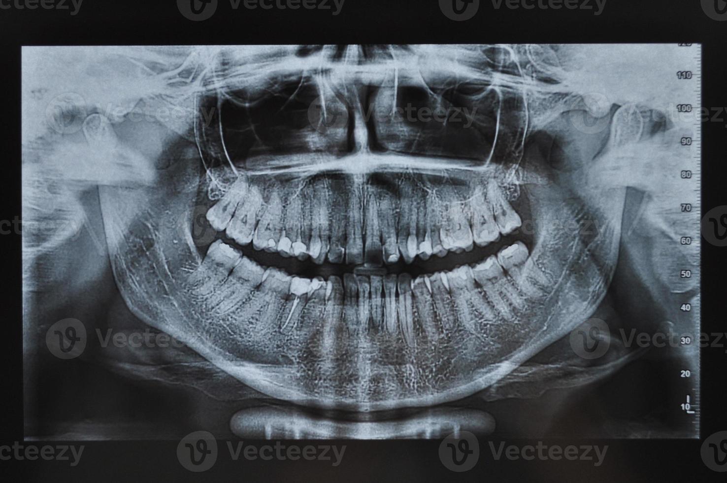 Zahnröntgen des gesamten Gesichts foto