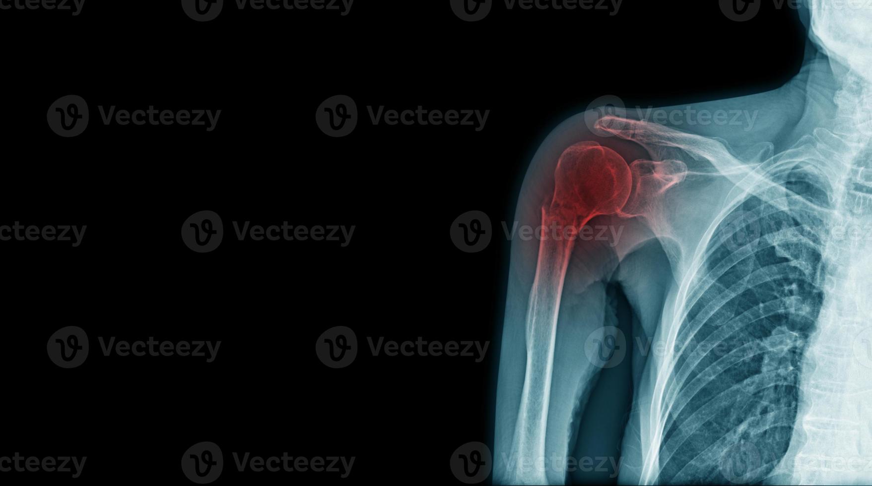 Röntgenfraktur des Akromionfortsatzes und des Humerushalses foto
