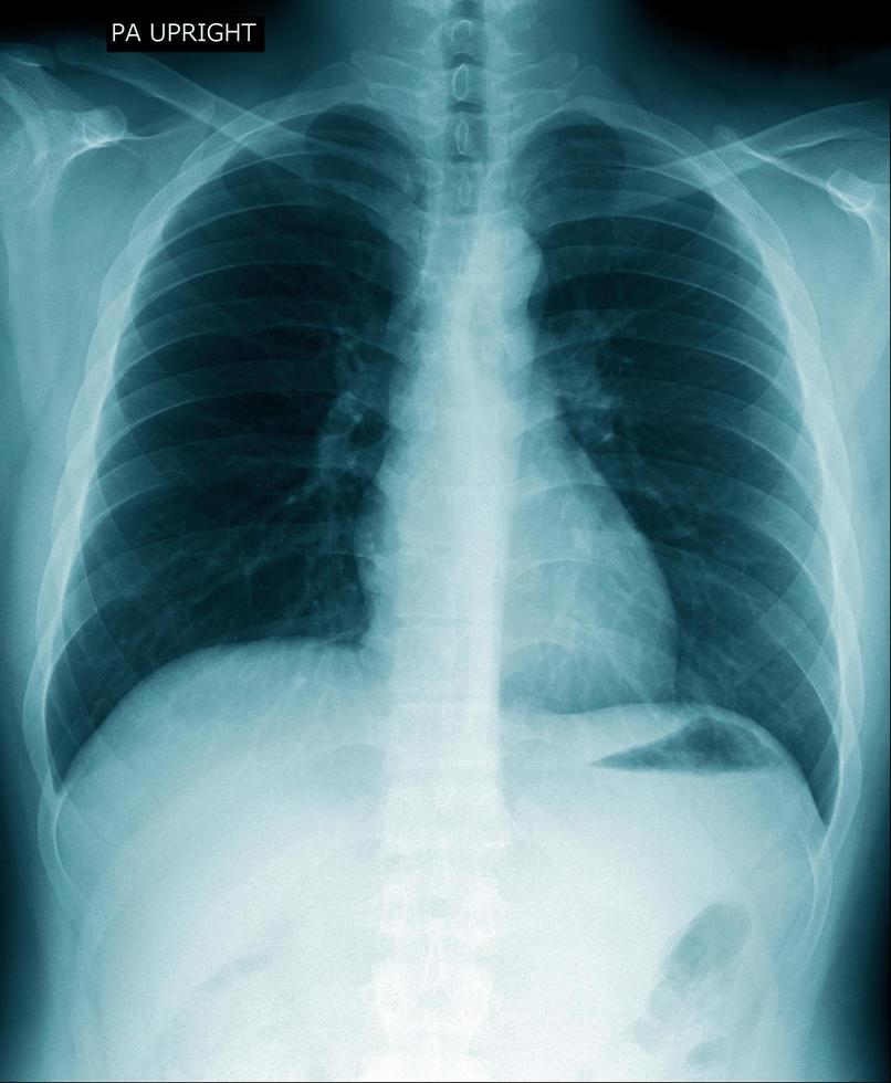 Röntgenaufnahme des Brustkorbs innerhalb der Lunge foto