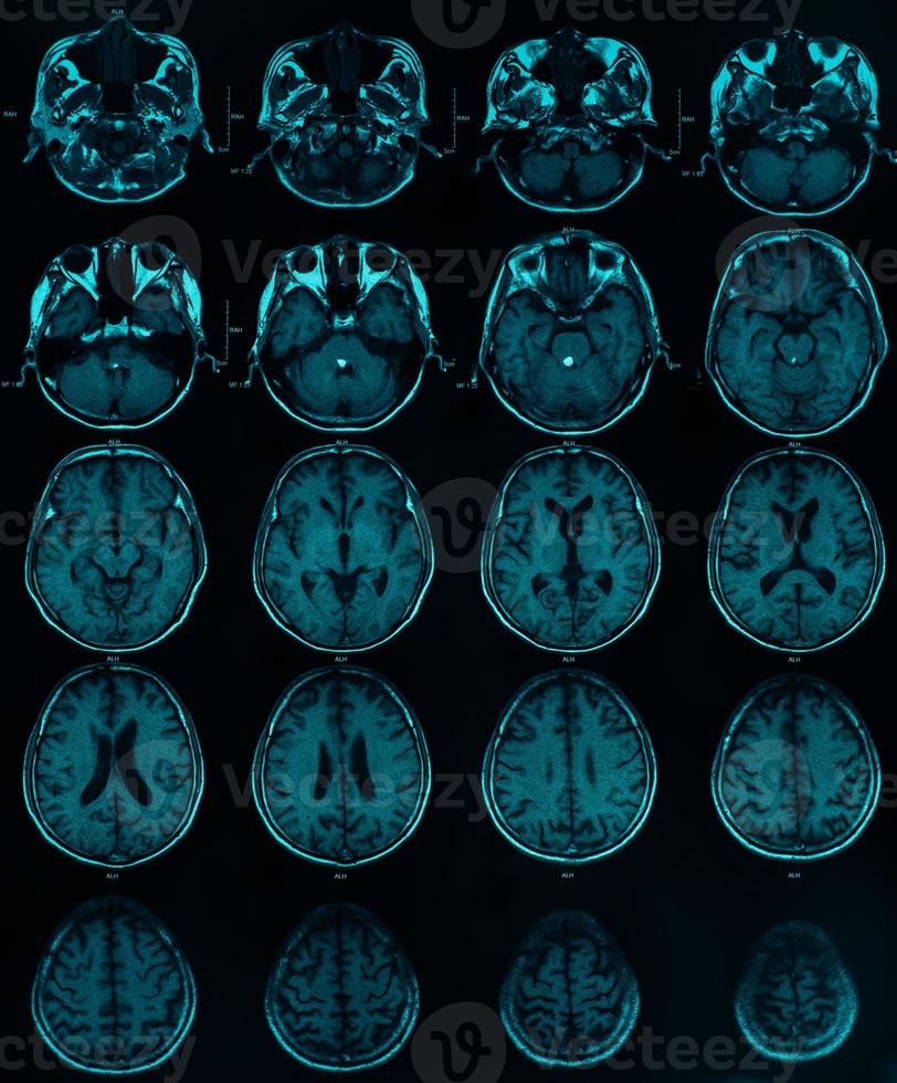 Bild des CT-MRT-Gehirns foto