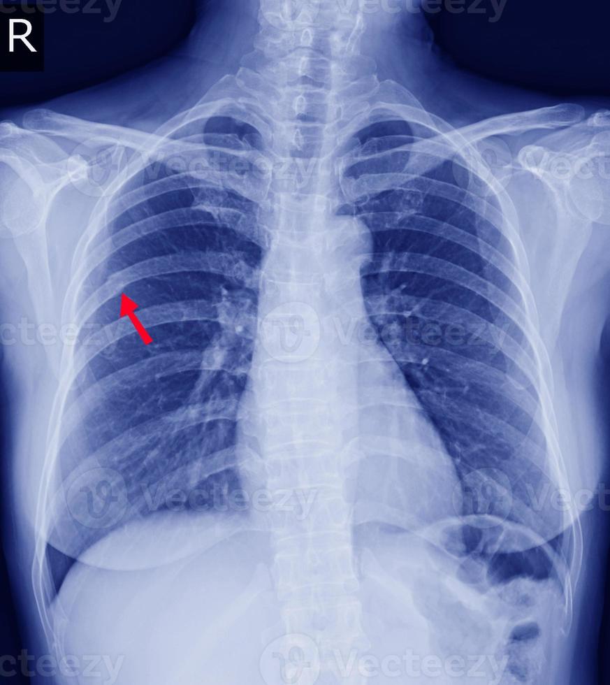 Brust-Röntgenfraktur rechte hintere 6. Rippe und mögliche seitliche Fraktur der linken 9. Rippe. foto